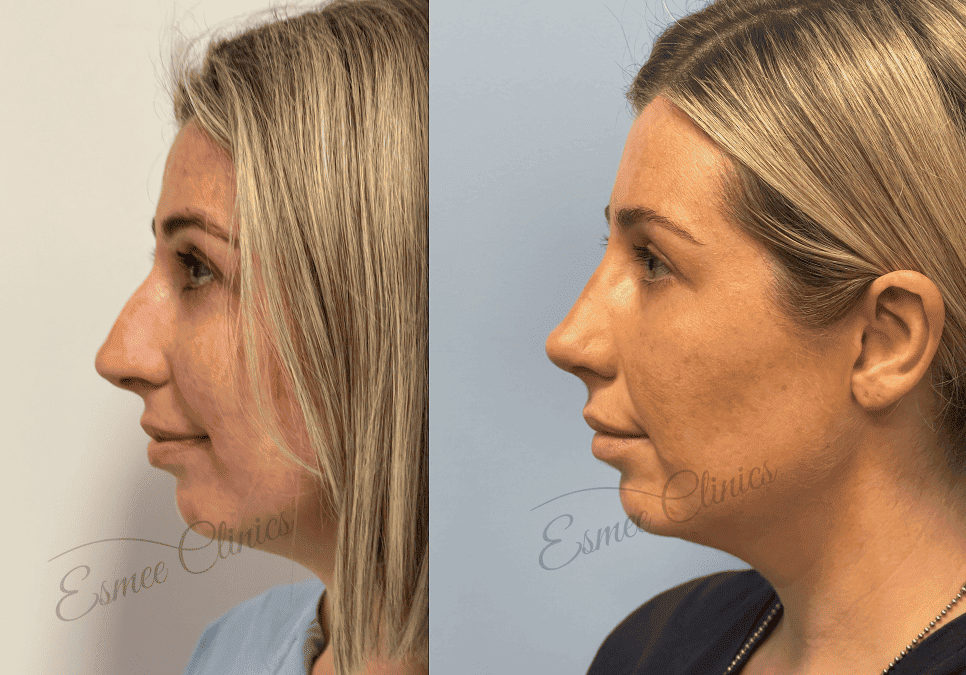 Before and After img